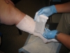 Medline - UNNA-Z™ - Unna Boot - NONUNNA3 - In Use