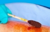 Dynarex® - Cotton Tipped Applicators - 4301 - In Use