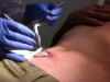Cardinal Health™ - Curity™ - Iodoform Packing Strips - 7831 - In Use
